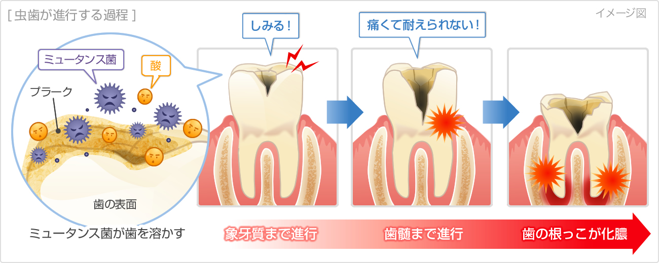 虫歯が進行する過程