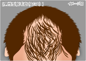 男性型脱毛症(AGA)