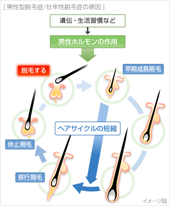 男性型脱毛症/壮年性脱毛症の原因