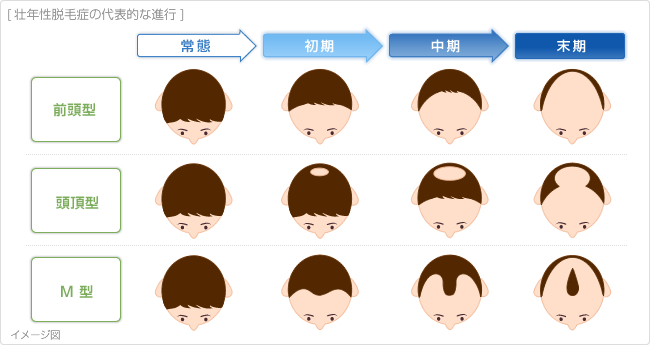 壮年性脱毛症の代表的な進行