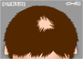 円形脱毛症