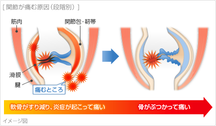 関節が痛む原因(段階別)