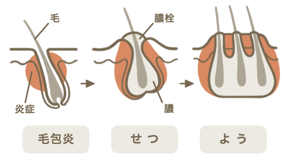 毛包炎の分類のイメージ図