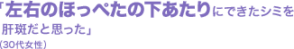 「左右のほっぺたの下あたりにできたシミを肝斑だと思った」(30代女性)
