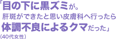 「目の下に黒ズミが。肝斑ができたと思い皮膚科へ行ったら体調不良によるクマだった」(40代女性)