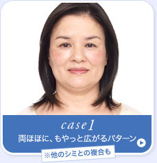 case1.���ققɁA������ƍL����p�^�[���i�����̃V�~�Ƃ̕������j