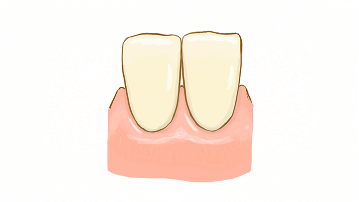 歯と歯のあいだの三角地帯 