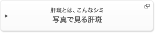 肝斑とは、こんなシミ写真で見る肝斑