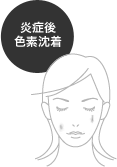 炎症後色素沈着