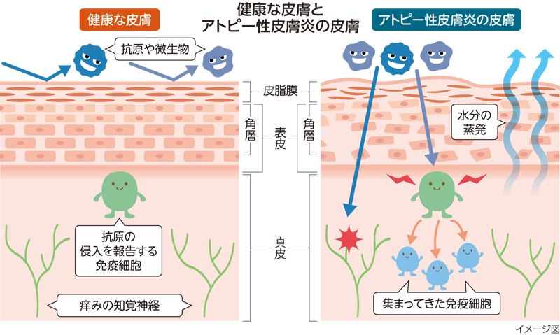 健康な皮膚とアトピー性皮膚炎の皮膚