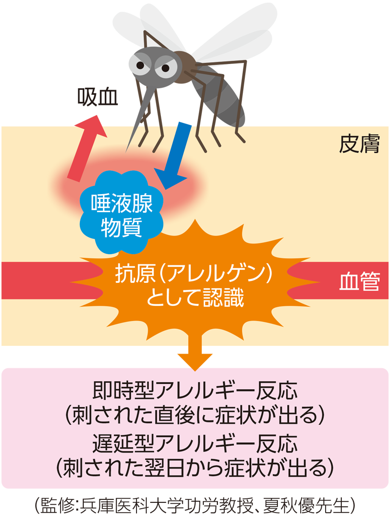 蚊に刺されてかゆみや腫れが生じるメカニズム