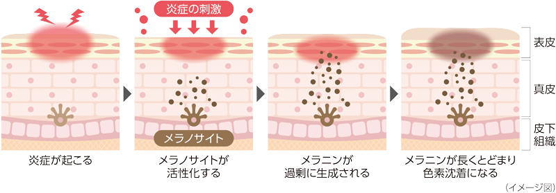 炎症後色素沈着が起こる仕組み
