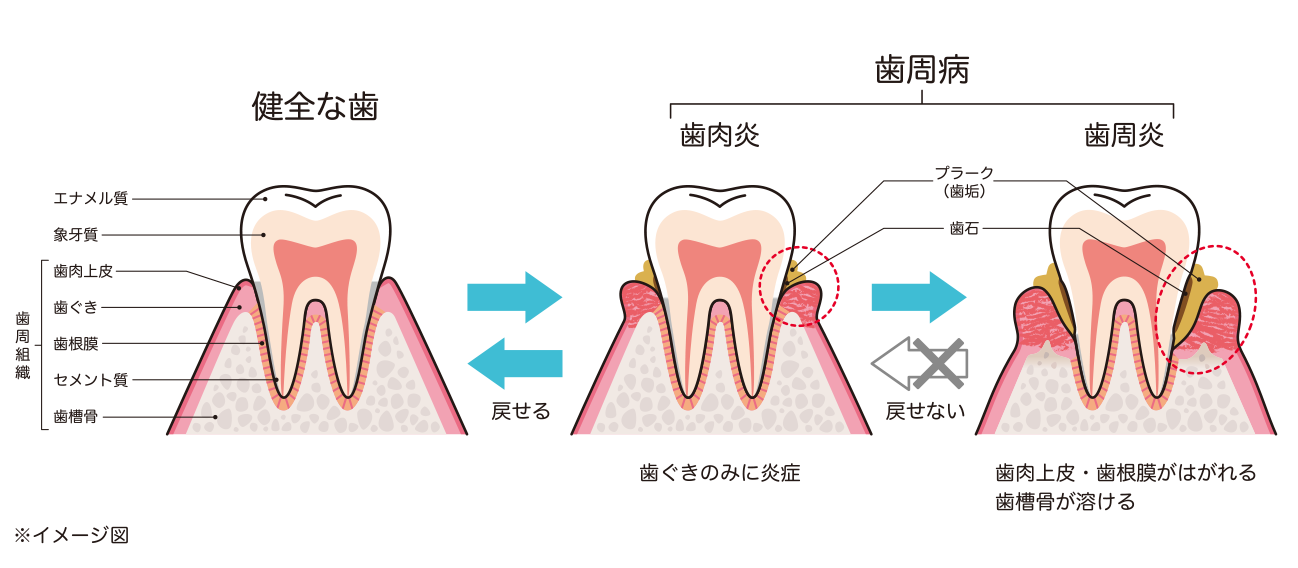 健康な歯と歯周病のイメージ図