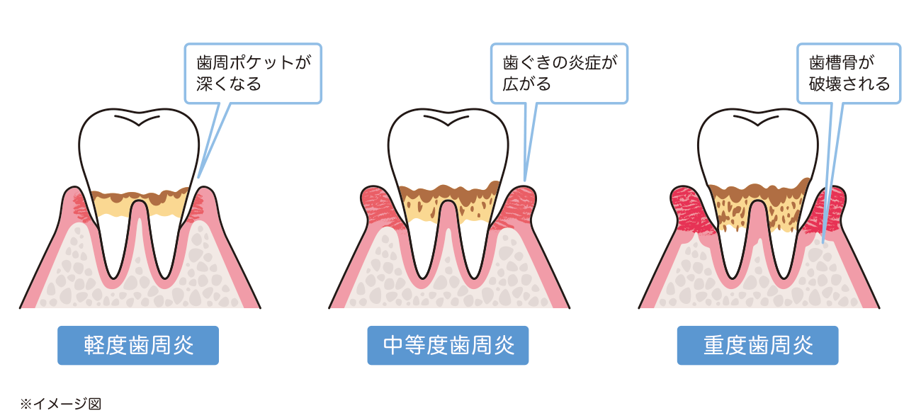 軽度歯周炎／中等度歯周炎／重度歯周炎