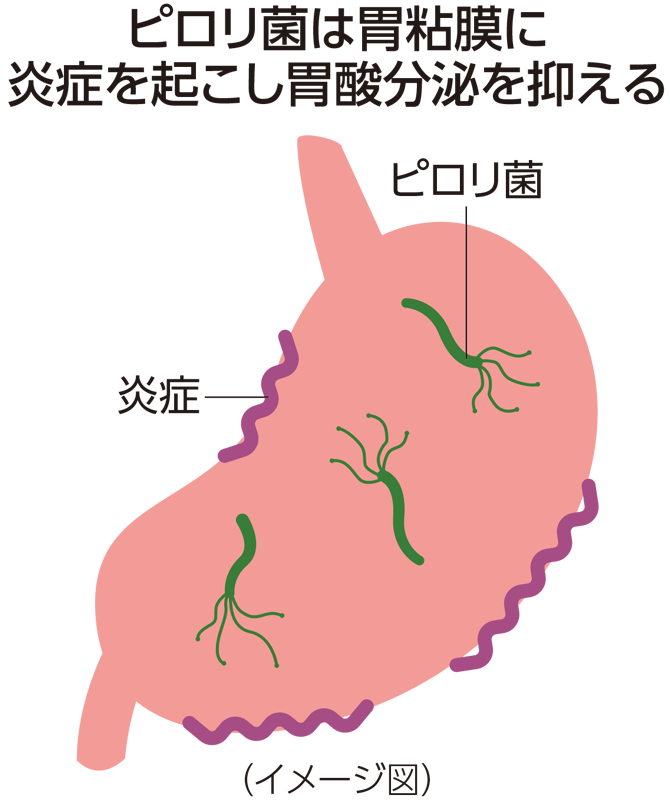 ピロリ菌は胃粘膜に炎症を起こし胃酸分泌を抑える