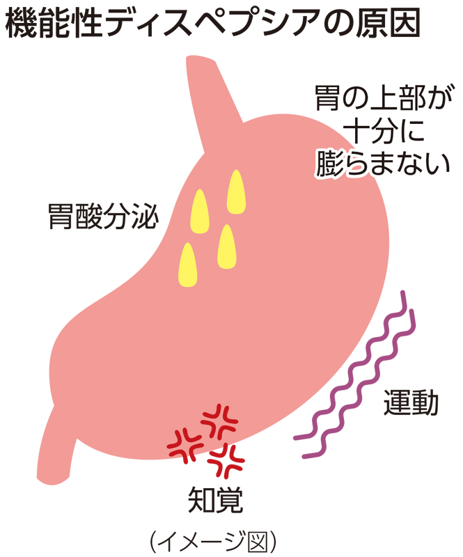 機能性ディスペプシアの原因