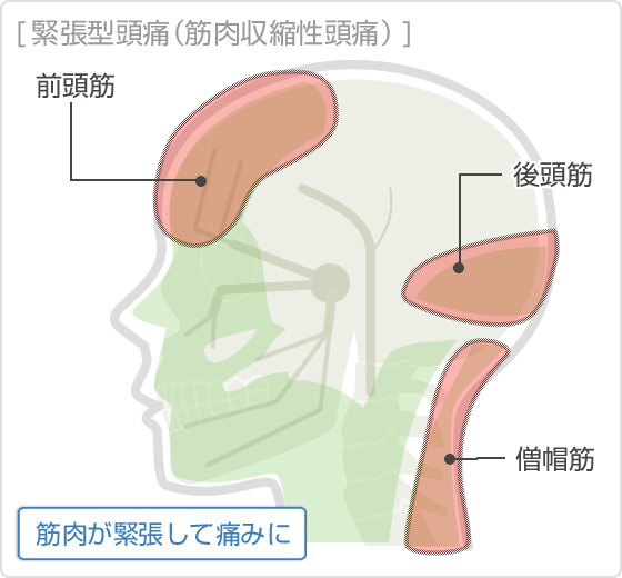 緊張型頭痛（筋肉収縮性頭痛）