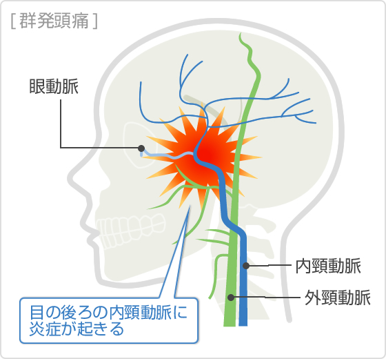 頭痛 群発 群発頭痛：原因、診断、治療