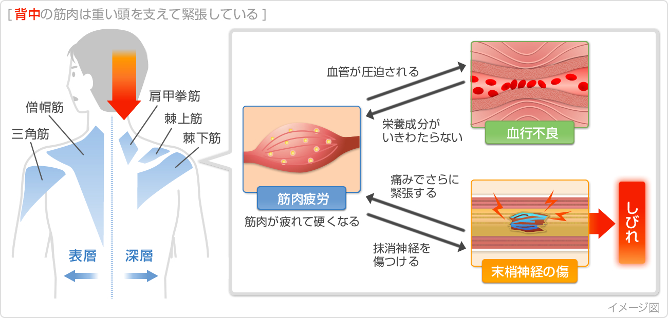 取り除く