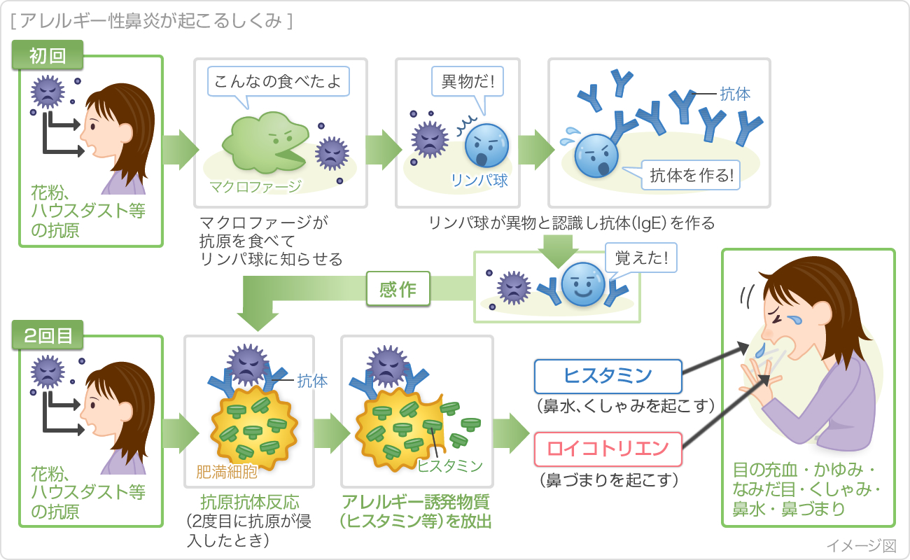季節性アレルギーや喘息が鼻ポリープを悪化させる可能性はありますか?
