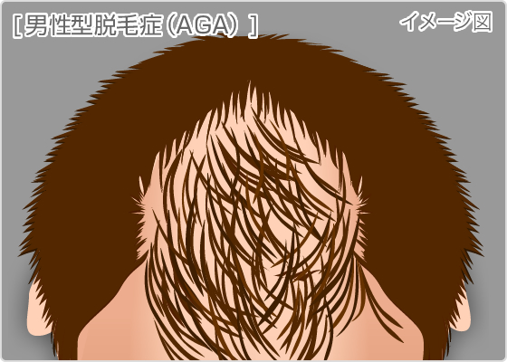 男性型脱毛症（AGA）