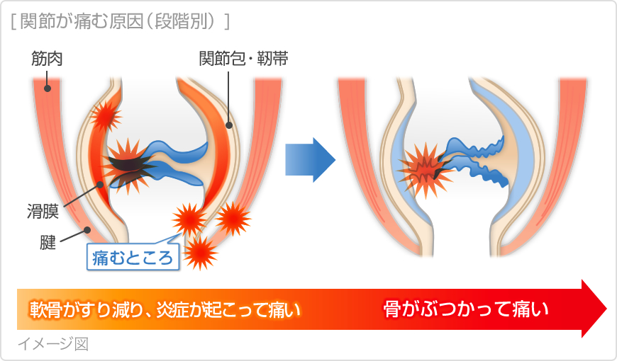 関節 の 痛み 熱