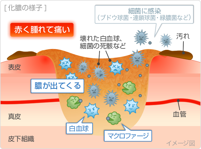 細菌性関節炎の治療法は何ですか?