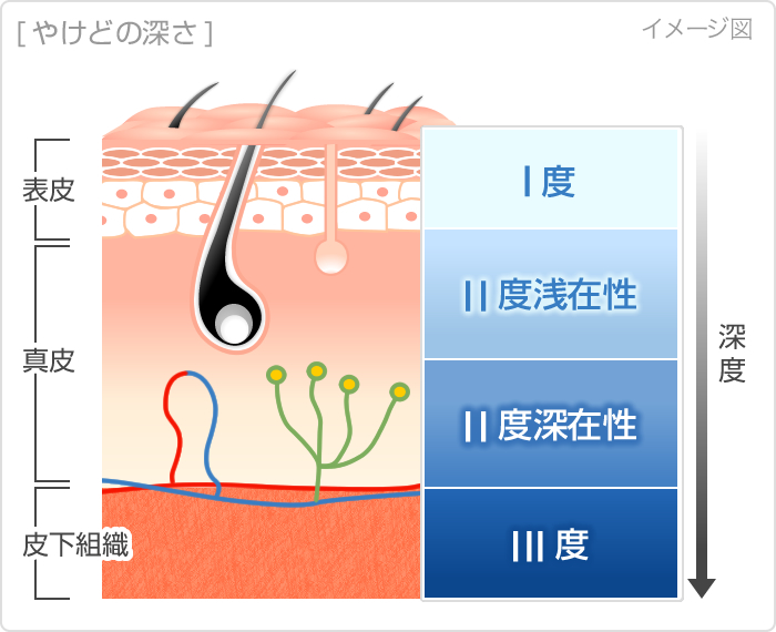 やけどの深さ