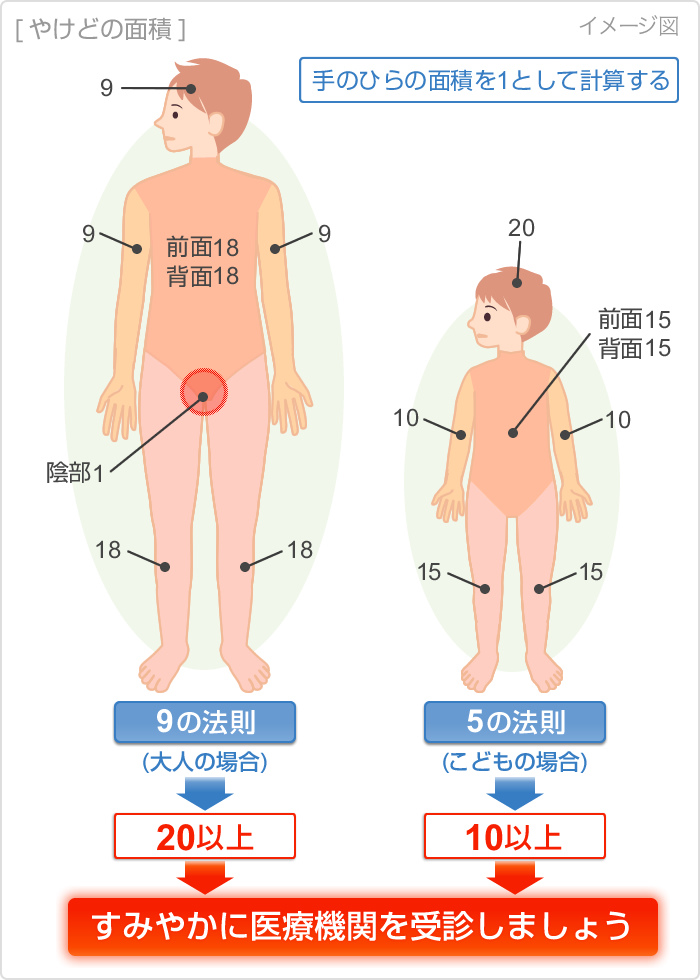 やけどの面積