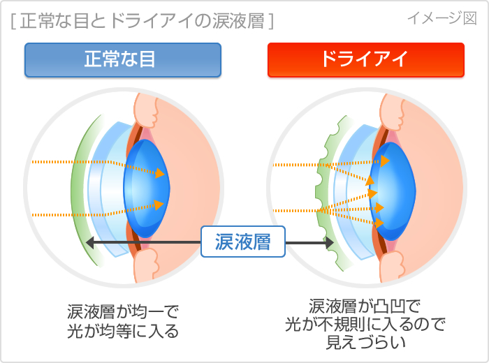 正常な目とドライアイの涙液層