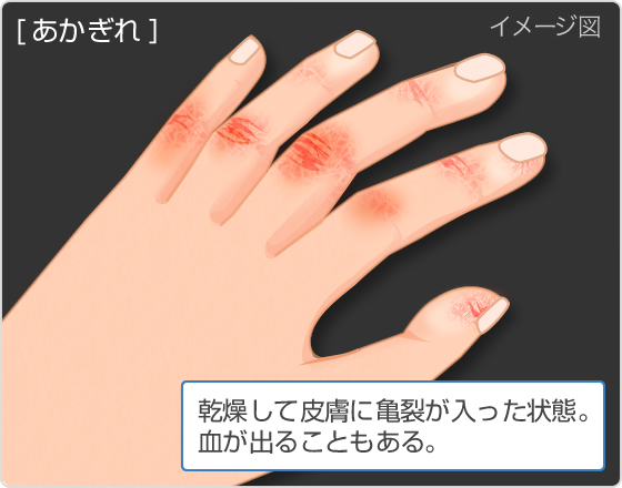 て 指 が の 血管 痛い 腫れ 原因なしで指がうっ血し青紫色のあざに