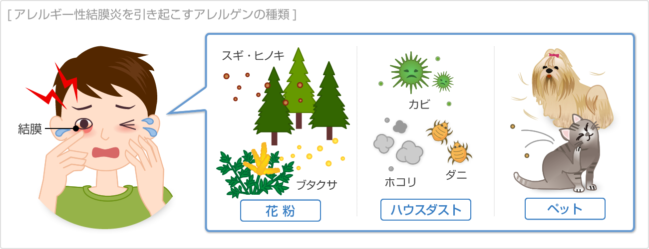 アレルギー性結膜炎を引き起こすアレルゲンの種類