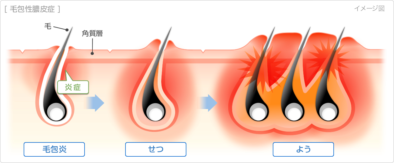 毛包性膿皮症