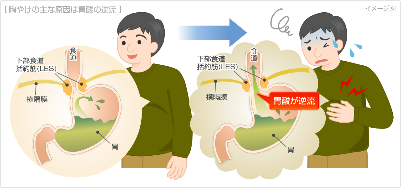 胃がむかむかする