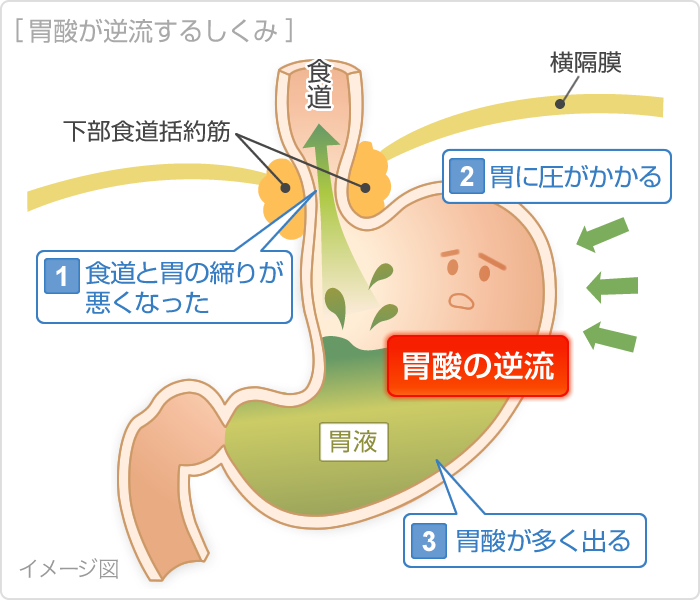 胆汁 が 胃 に 逆流