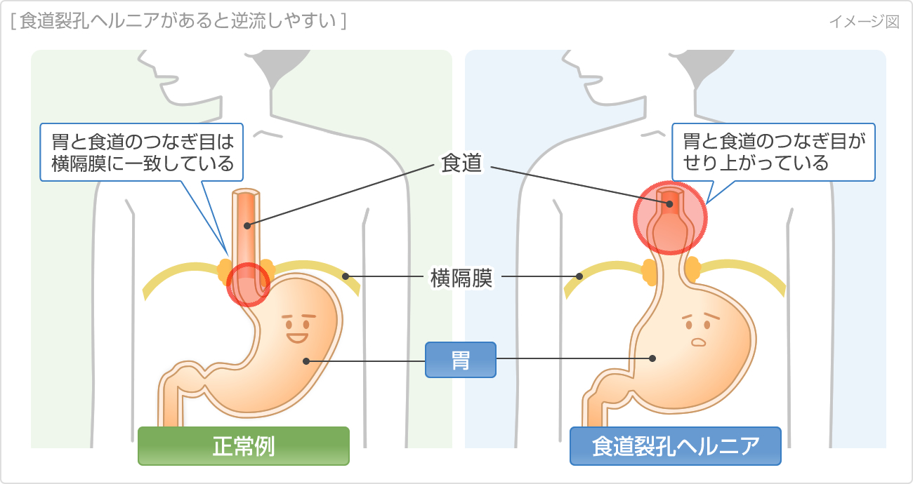 食道裂孔ヘルニアの症状を治療するための運動とストレッチ