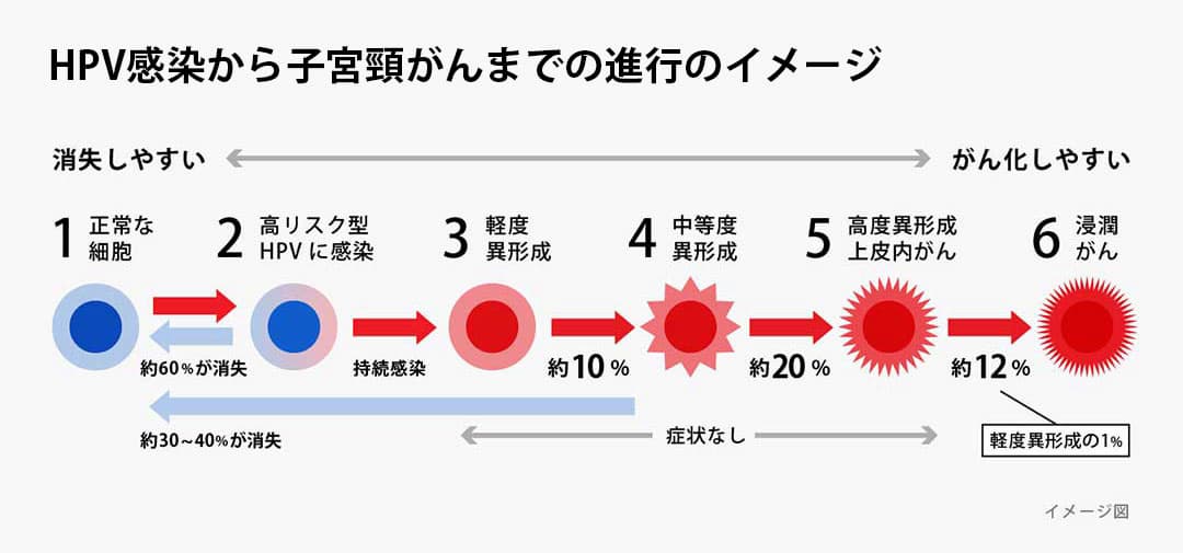 HPV感染から子宮頸がんまでの進行のイメージ