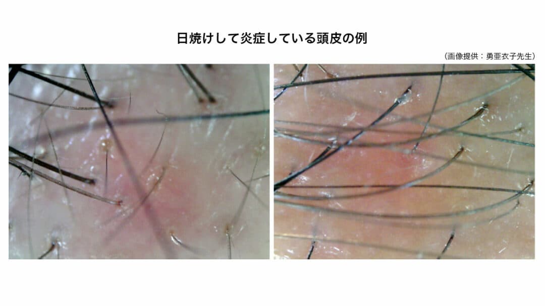 日焼けして炎症している頭皮の例（画像提供：勇亜衣子先生）