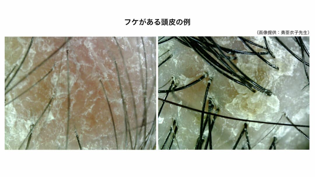 フケがある頭皮の例（画像提供：勇亜衣子先生）