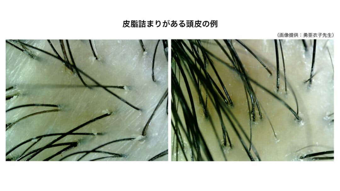 皮脂詰まりがある頭皮の例(画像提供:勇亜衣子先生)