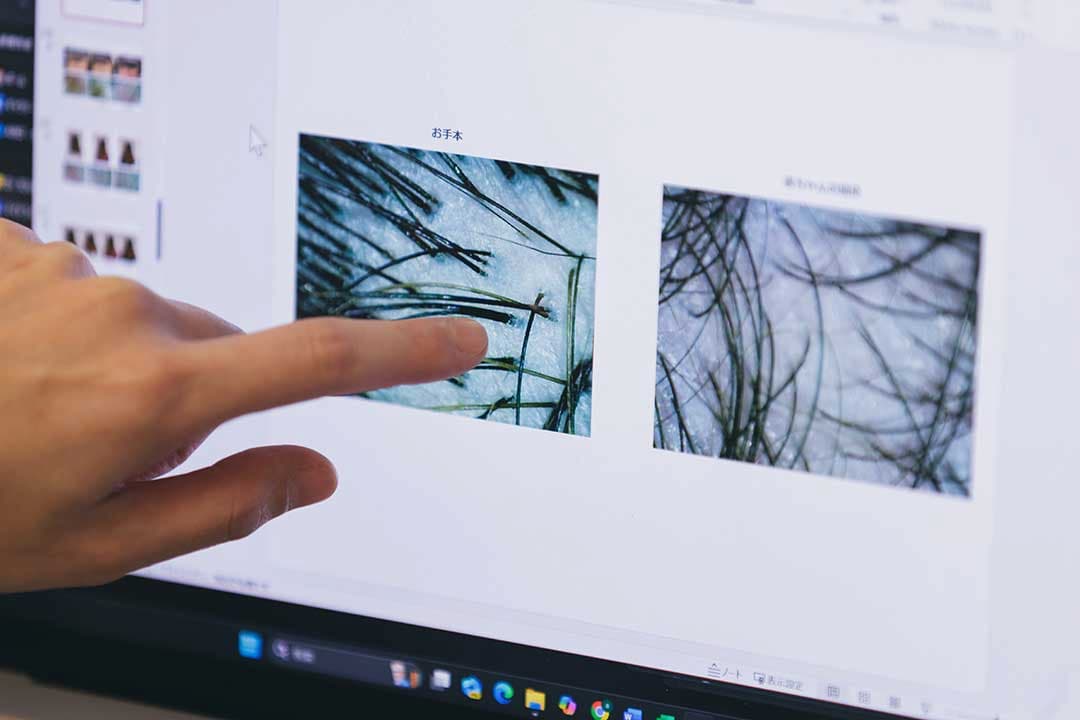「すこやかな頭皮」の写真を使って説明する勇先生