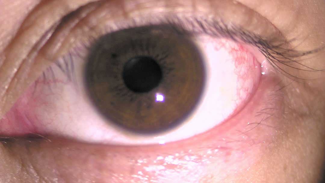 充血している目の様子