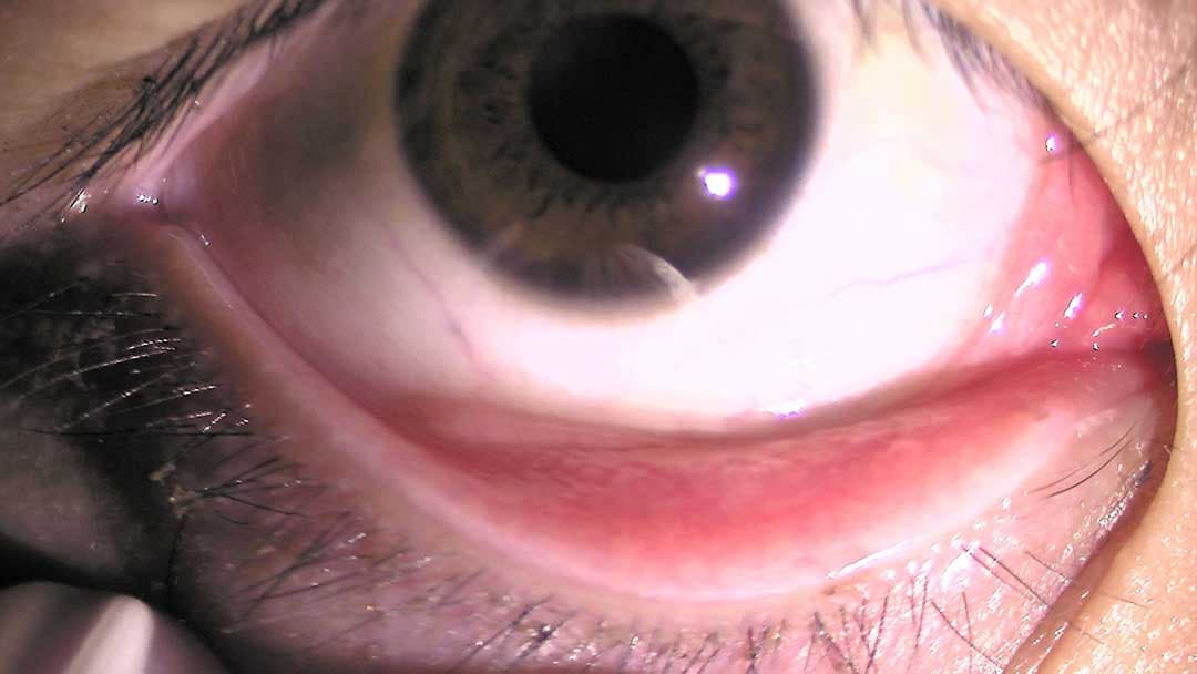 ウイルス性結膜炎の様子