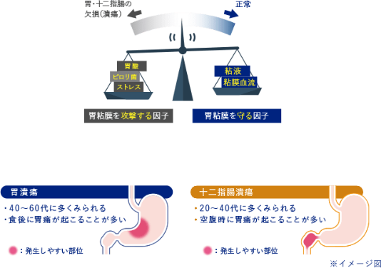 胃酸、ピロリ菌、ストレス 胃粘膜を攻撃する因子 粘液、粘膜血流 胃粘膜を守る因子 胃潰瘍 40から60代に多くみられる 食後に胃痛が起こることが多い 十二指腸潰瘍 20から40代に多くみられる 空腹時に胃痛が起こることが多い