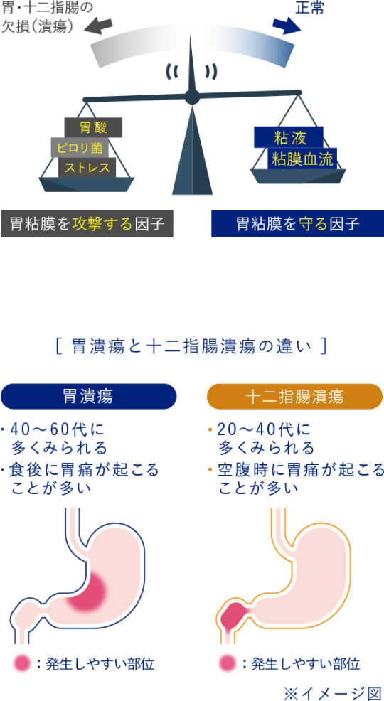 胃酸、ピロリ菌、ストレス 胃粘膜を攻撃する因子 粘液、粘膜血流 胃粘膜を守る因子 胃潰瘍 40から60代に多くみられる 食後に胃痛が起こることが多い 十二指腸潰瘍 20から40代に多くみられる 空腹時に胃痛が起こることが多い