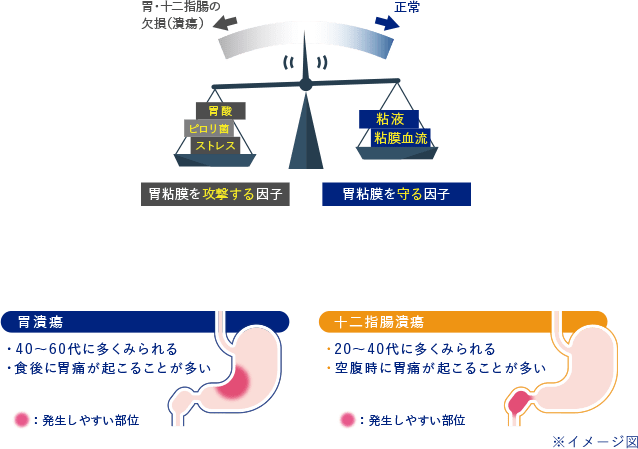 胃痛の原因 胃痛について 胃痛 もたれなどの胃の不快な症状に ガスター10 第一三共ヘルスケア 胃痛の原因 胃痛について 胃痛 もたれなどの胃の不快な症状に ガスター10 第一三共ヘルスケア