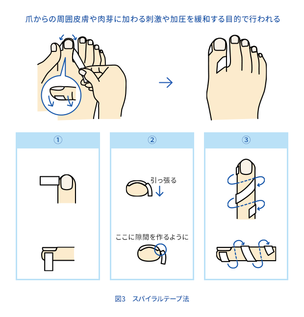 爪 周囲 炎 自分 で 治す