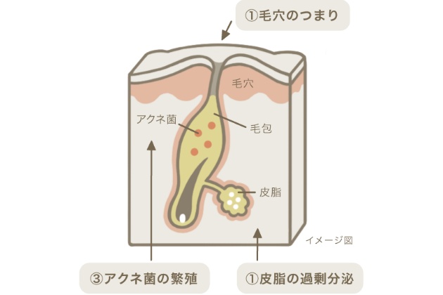 ニキビの原因は、主に3つ考えられます。