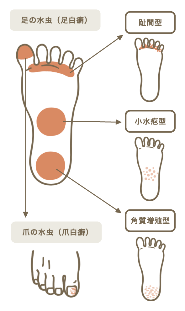 水虫 足白癬 皮膚症状一覧 ひふ研 ひふ症状 ひふ薬の使い方の疑問に答える情報サイト 第一三共ヘルスケア