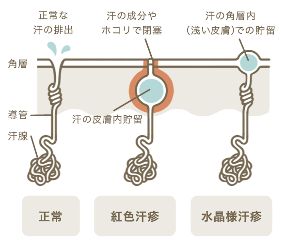 あせも 汗疹 皮膚症状一覧 ひふ研 ひふ症状 ひふ薬の使い方の疑問に答える情報サイト 第一三共ヘルスケア